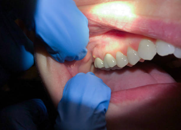 Best Emergency Gum Treatment in Shorewood, WI